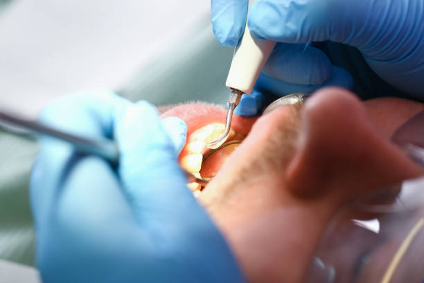 Best Emergency Wisdom Tooth Extraction in Odem, TX